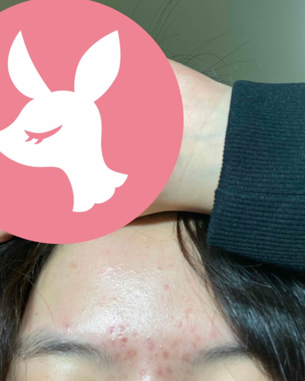 のの on LIPS 「約2ヶ月が経ちました。全く良くならないです、誰かニキビが無くな..」(4枚目)