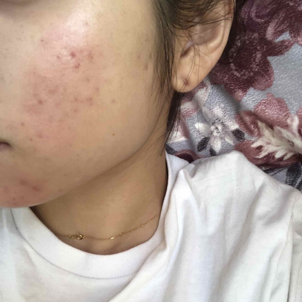 エピデュオゲル/マルホ株式会社/その他を使ったクチコミ（3枚目）