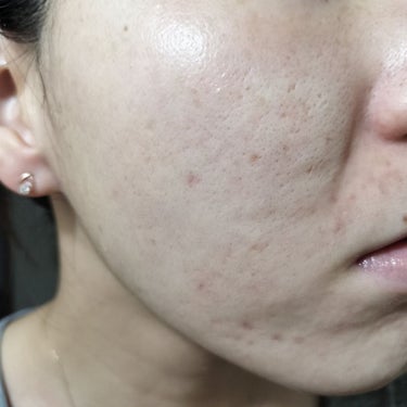 Glucolic Acid 30% Gel Peel/YEOUTH/ピーリングを使ったクチコミ（1枚目）