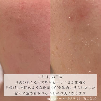 ダーマスキンピーリング/BQCELL/その他キットセットを使ったクチコミ(4枚目)