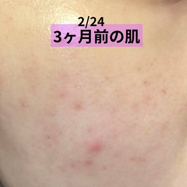 AHA 30% + BHA 2% Peeling Solution/The Ordinary/ピーリングを使ったクチコミ（2枚目）