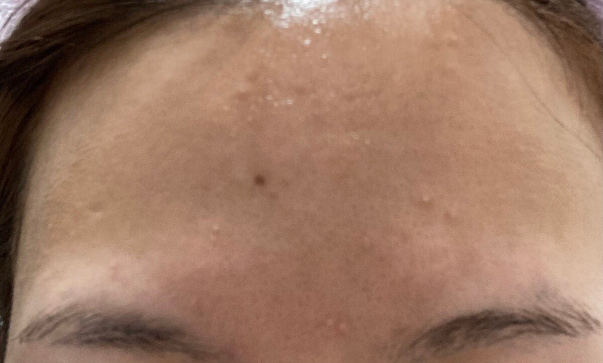 アクネキュアクリーム(医薬品)/IHADA/その他を使ったクチコミ(2枚目)