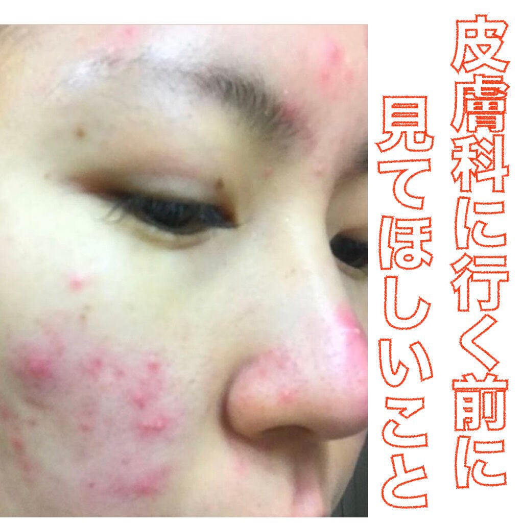 みん on LIPS 「肌荒れしてる方ならば1度は行ったことがあるであろう皮膚科につい..」(1枚目)