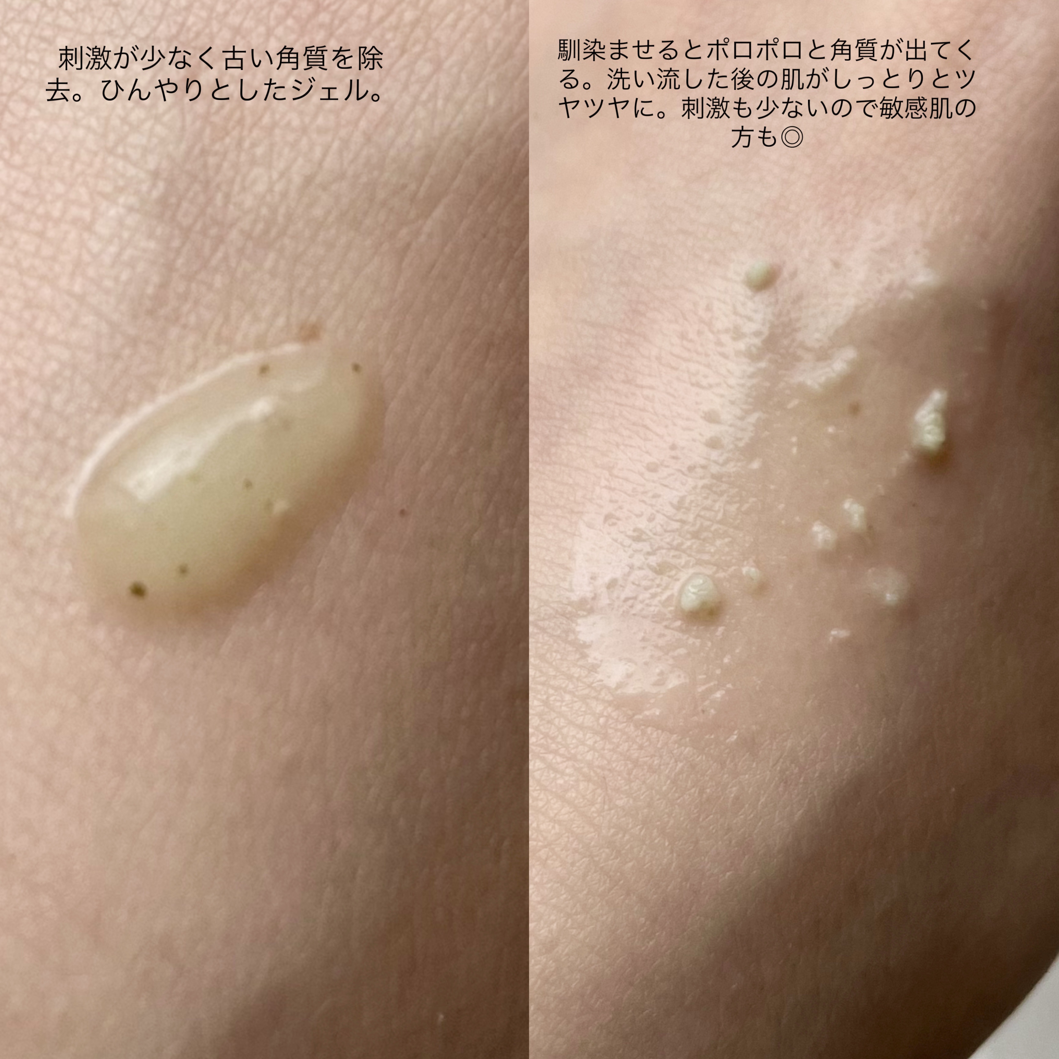 クリーンイットゼロポアティーツリーピーリングジェル/BANILA CO/ピーリングを使ったクチコミ（2枚目）