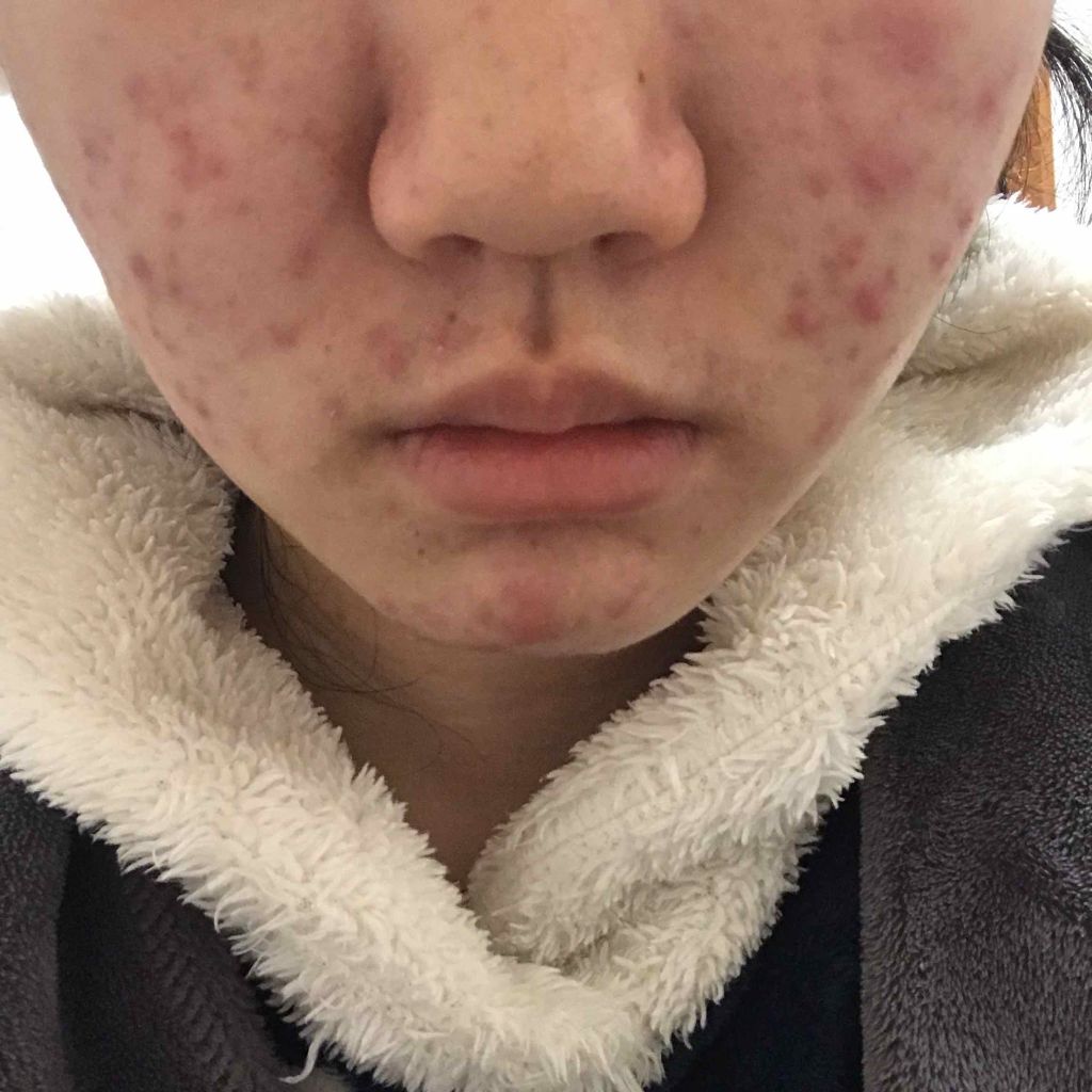 薬用 しみ 集中対策 美容液/メラノCC/美容液を使ったクチコミ（2枚目）