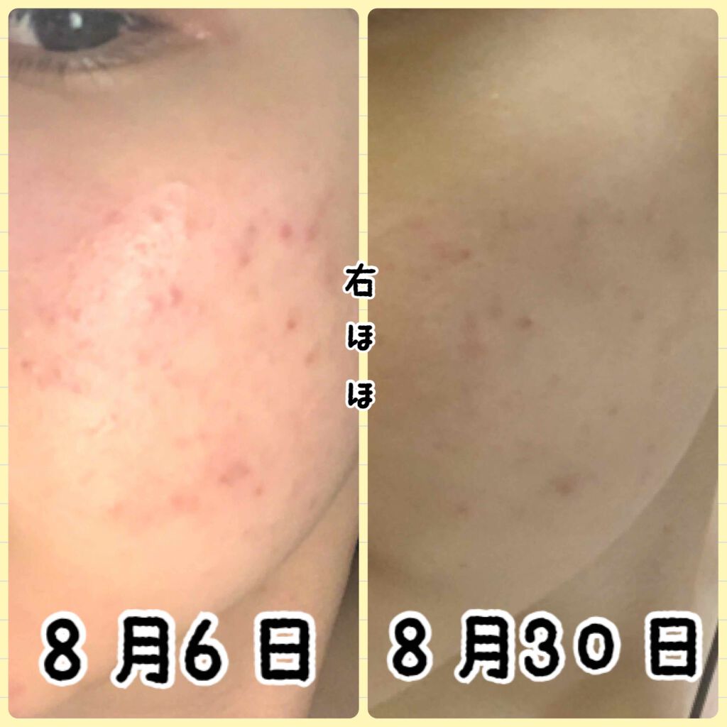 DHC はとむぎエキス/DHC/健康サプリメントを使ったクチコミ（2枚目）