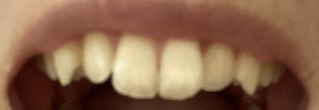 クレスト3Dホワイトニング ホワイトストリップ プロフェッショナル エフェクツ/クレスト/その他オーラルケアを使ったクチコミ（2枚目）