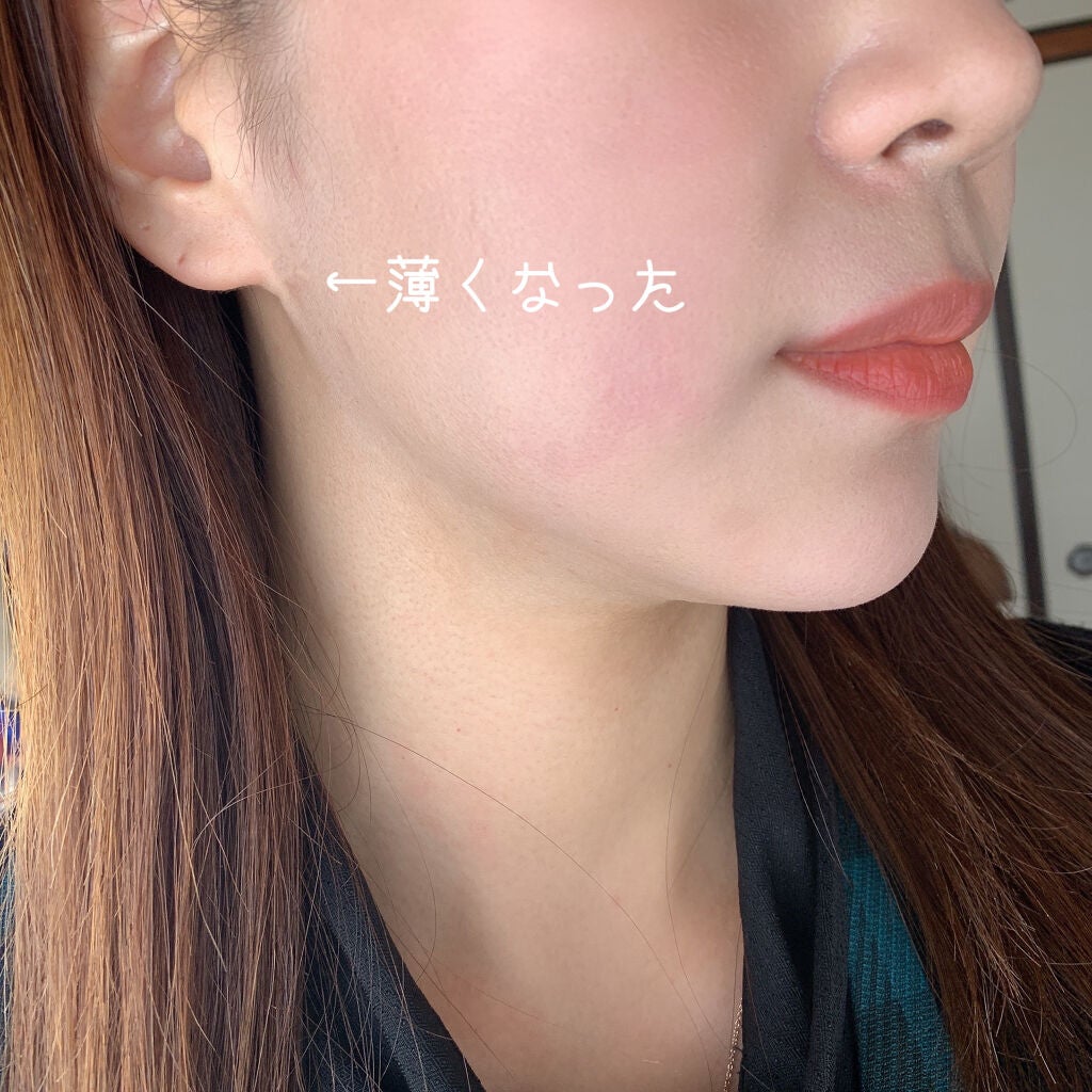 あこ❀cosme on LIPS 「17skin高濃度ビタミンC(2000mg配合)美容皮膚科医院..」(5枚目)