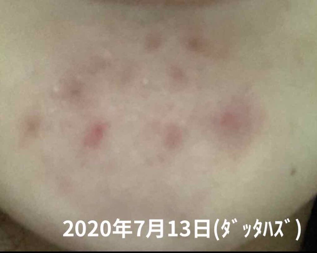 オードムーゲ 薬用ローション(ふきとり化粧水)/オードムーゲ/拭き取り化粧水を使ったクチコミ(2枚目)