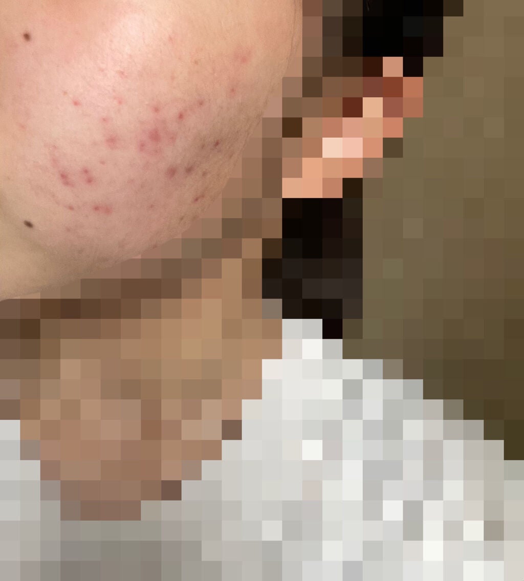 ニキビ治療薬(医薬品)/メンソレータム アクネス/その他を使ったクチコミ(2枚目)