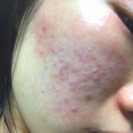 エピデュオゲル/マルホ株式会社/その他を使ったクチコミ(3枚目)