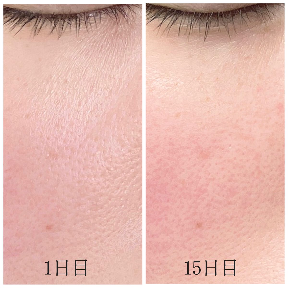 とことこ on LIPS 「#ビタC30日毛穴レスチャレンジ15日目になりました〜!!毎日..」(3枚目)