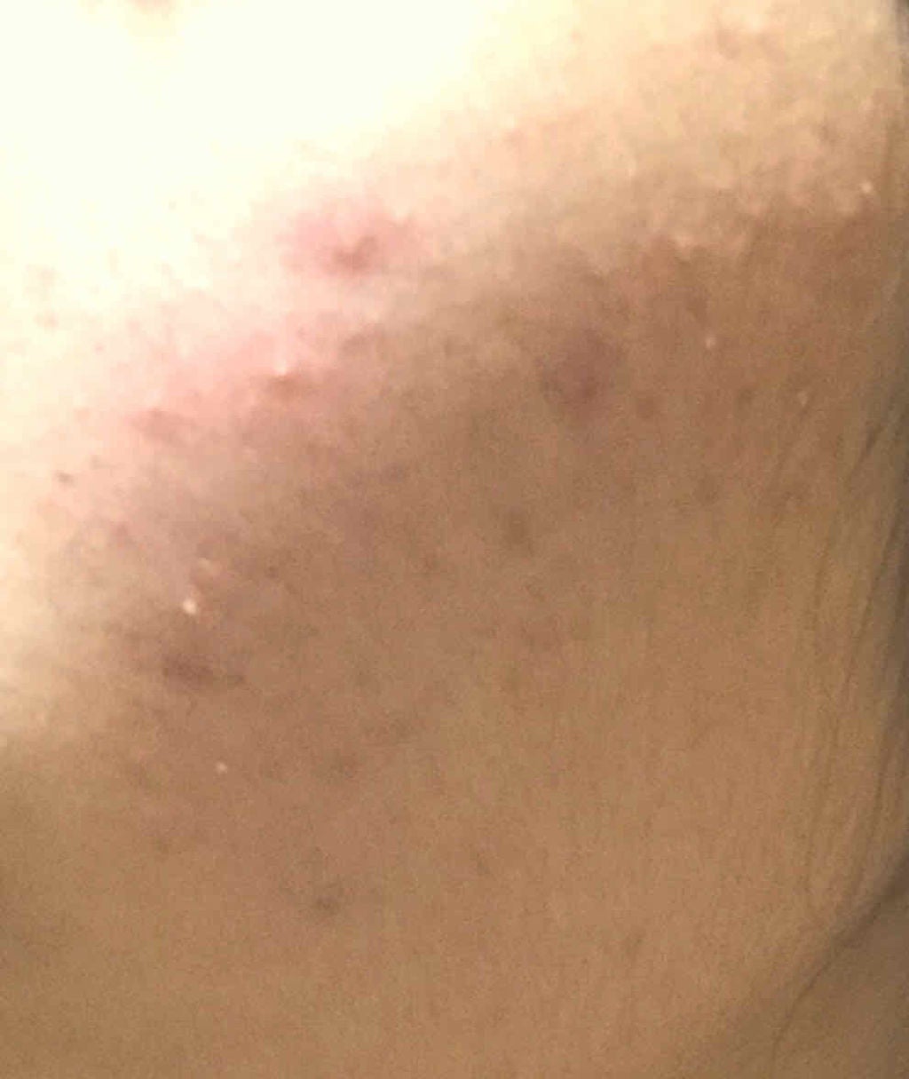 マシュマロホイップ 薬用アクネケア/ビオレ/泡洗顔を使ったクチコミ(2枚目)