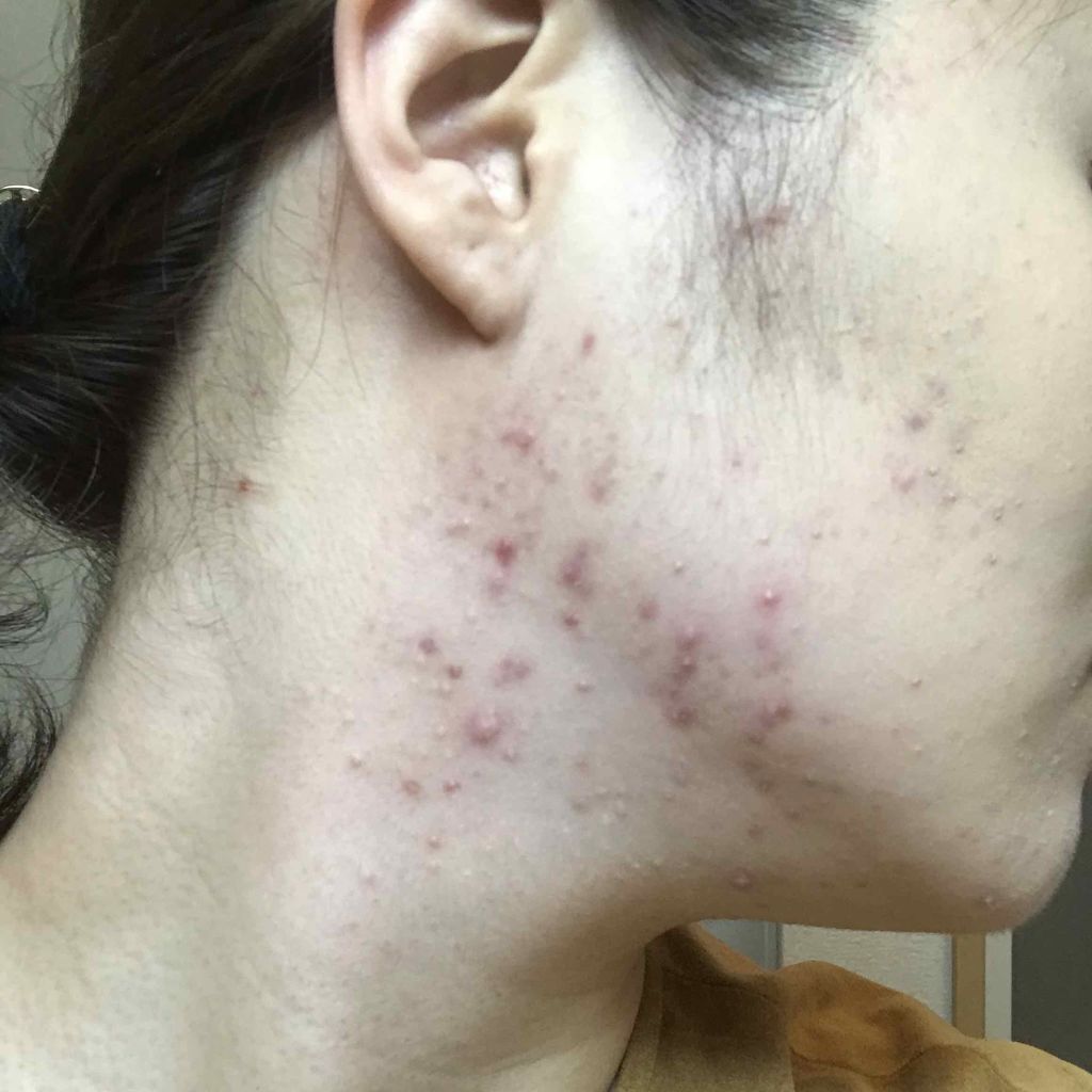 アクネ クラリファイング ローション/CLINIQUE/化粧水を使ったクチコミ（2枚目）