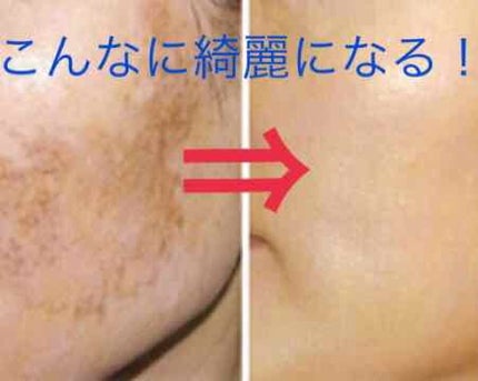 クリアホワイトスキン/ミリオナ化粧品/フェイスクリームを使ったクチコミ(3枚目)