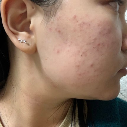 ティーツリーケア ソリューション エッセンシャルマスクEX/MEDIHEAL/シートマスク・パックを使ったクチコミ(2枚目)