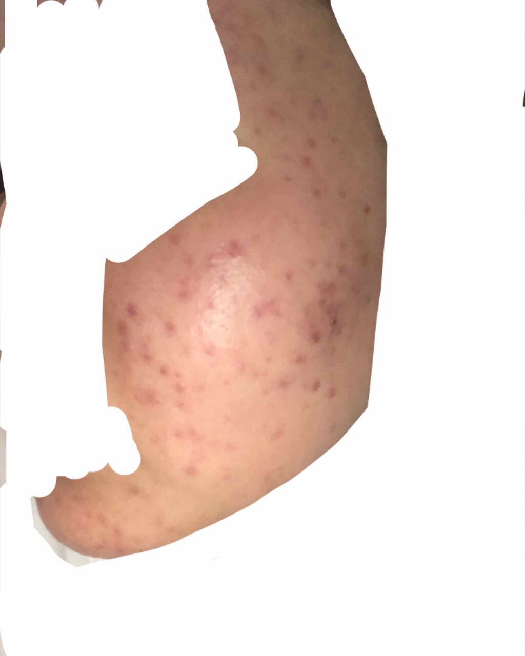 ななみ on LIPS 「皮膚科へ行き、ペピオゲルを処方してもらいました。使い始めてから..」(2枚目)