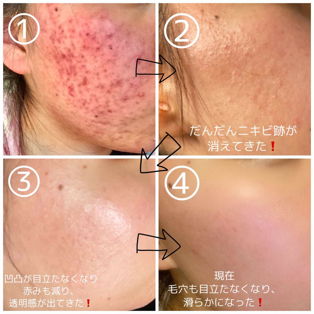 ティーツリーケアソリューション アンプルマスクJEX/MEDIHEAL/シートマスク・パックを使ったクチコミ（3枚目）