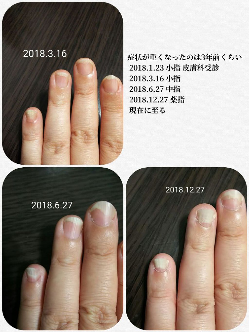 クイックケアコート Ettusaisを使った口コミ お見苦しい画像があります 重度の爪甲剥離 By かぴめろん 訪問率低下 深謝 乾燥肌 40代後半 Lips