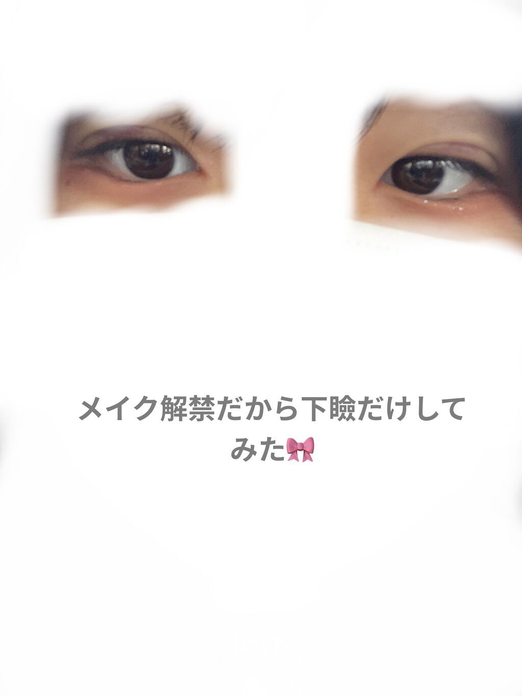 二重整形/その他を使ったクチコミ（2枚目）