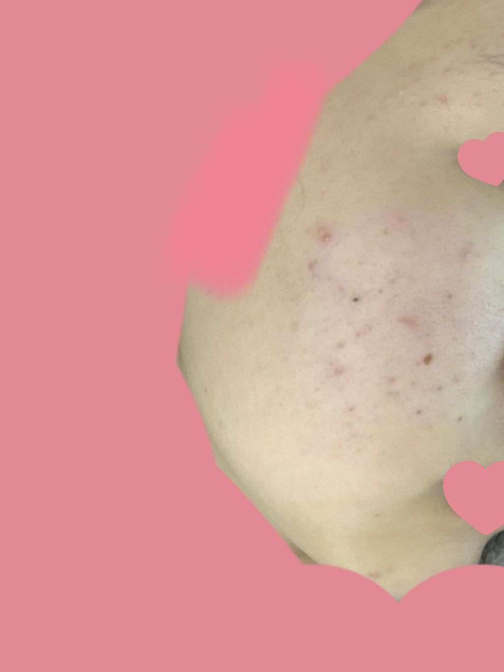 ペアアクネクリームW(医薬品)/ペア/その他を使ったクチコミ（3枚目）