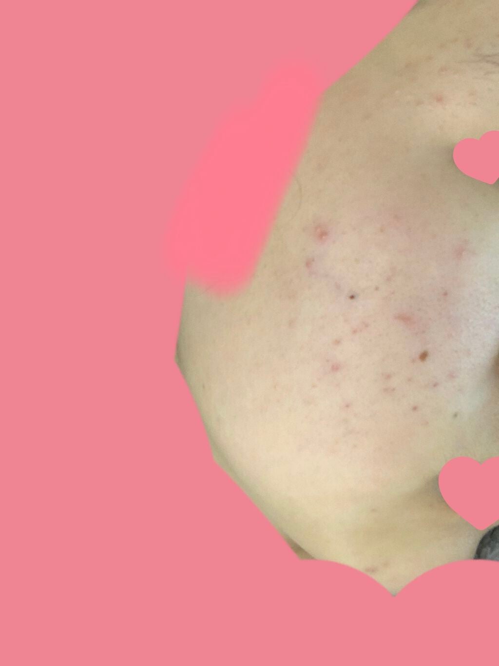 ペアアクネクリームW(医薬品)/ペア/その他を使ったクチコミ(3枚目)