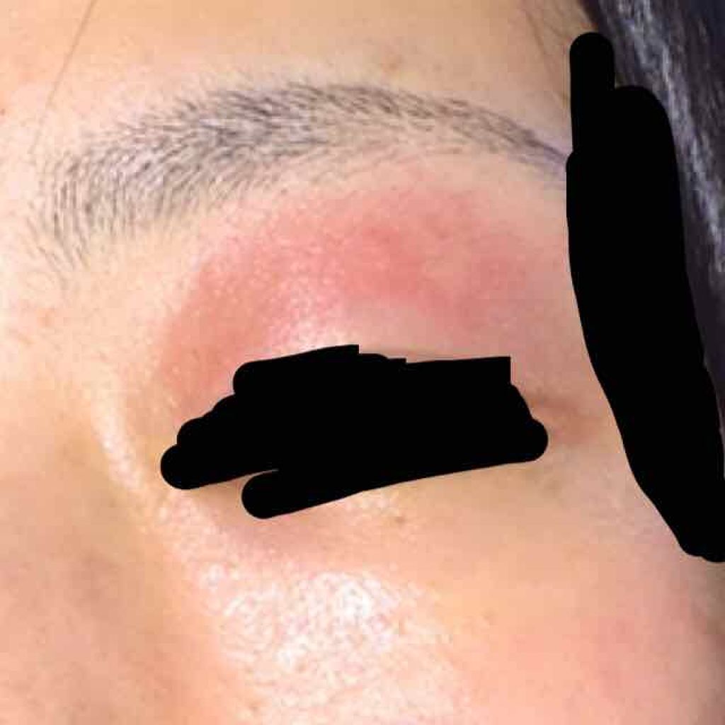 柚月 on LIPS 「※治療中の写真あります。赤みやただれかけている画像もありますの..」(3枚目)