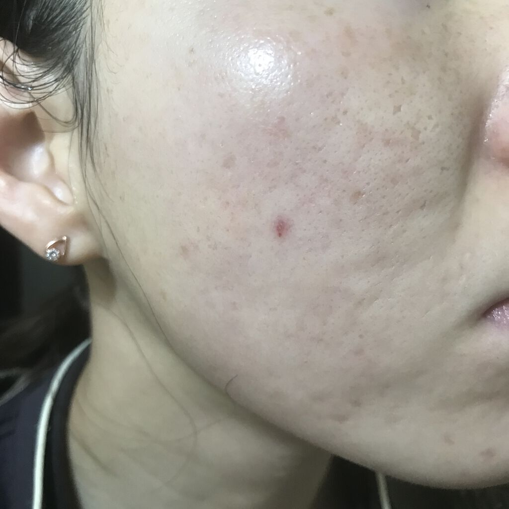 レチノールA 1% アドバンスドリバイタリゼーションクリーム/Life-flo/フェイスクリームを使ったクチコミ（1枚目）