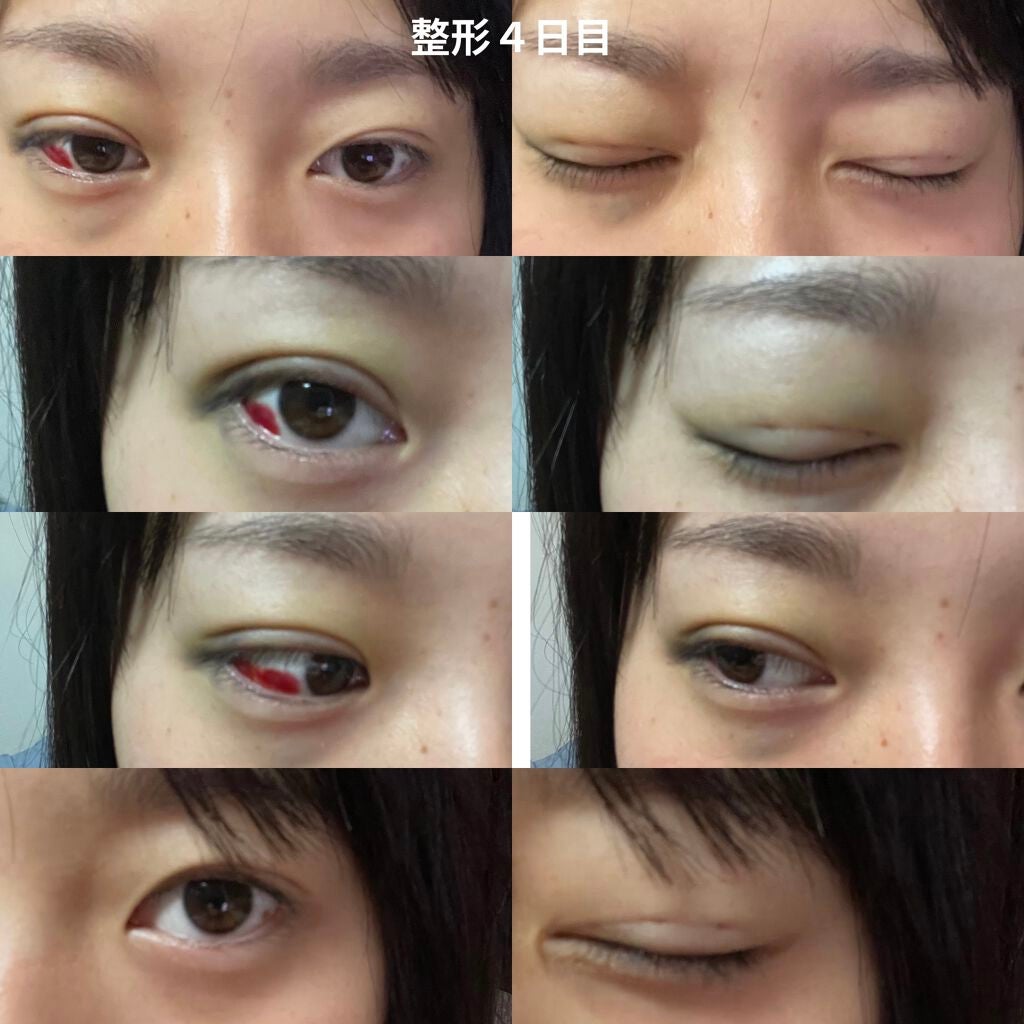 なつ on LIPS 「二重整形(埋没)しました整形記録1閲覧注意2日目〜 右目眼球内..」(5枚目)