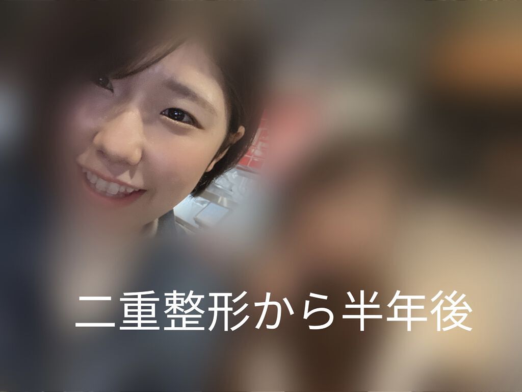 二重整形/その他を使ったクチコミ（1枚目）