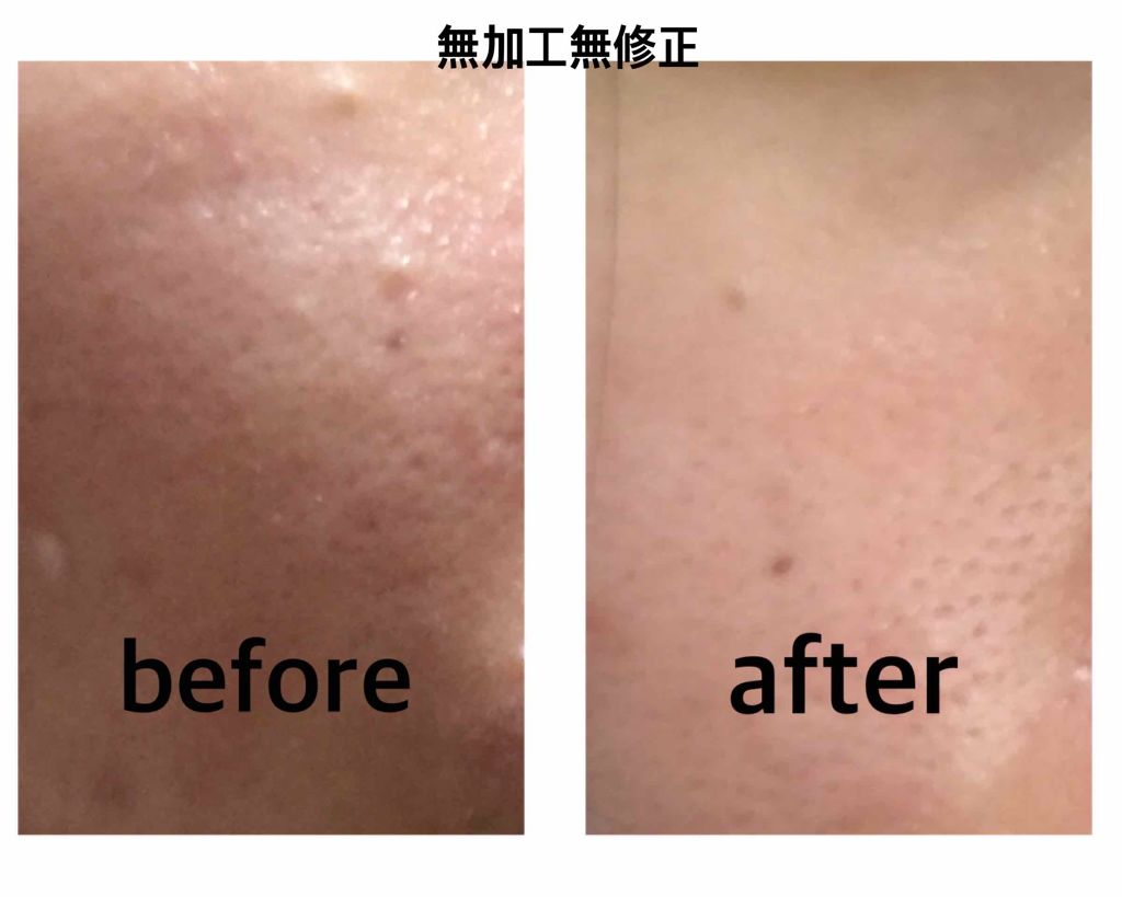 ベピオゲル/マルホ株式会社/その他を使ったクチコミ（2枚目）