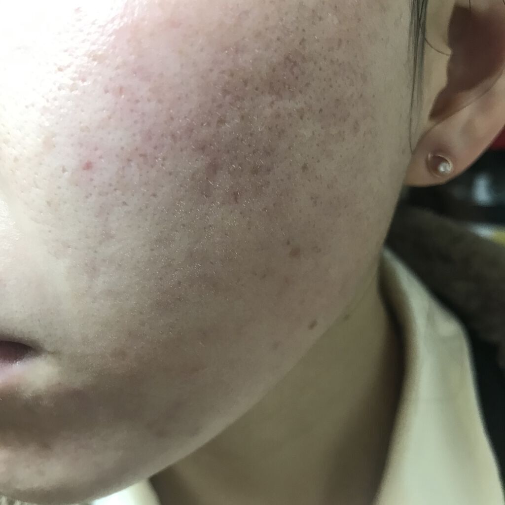 Azelaic Acid Suspension 10%/The Ordinary/美容液を使ったクチコミ（2枚目）