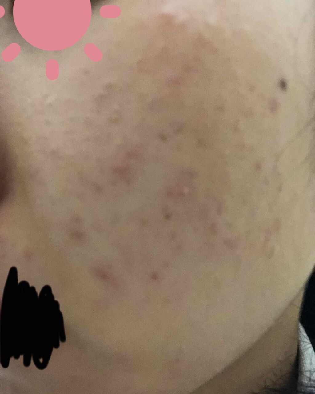 ペアアクネクリームW(医薬品)/ペア/その他を使ったクチコミ（3枚目）