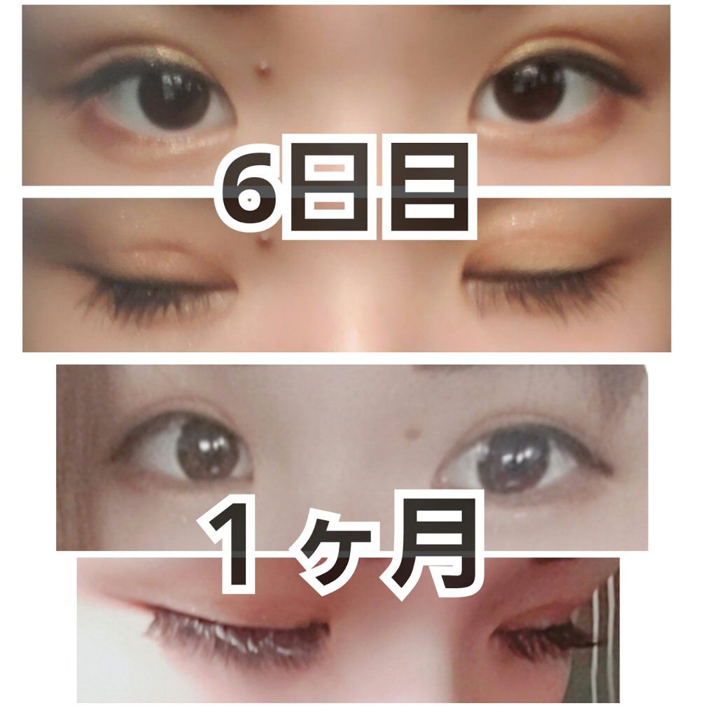 える。 on LIPS 「皆様こんにちは、#える。です!!今日は#二重整形の#埋没法につ..」(4枚目)