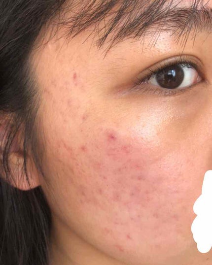 にき子 on LIPS 「【ニキビ治療記録】なおらないつかれたー!とりあえず写真だけ載せ..」(2枚目)