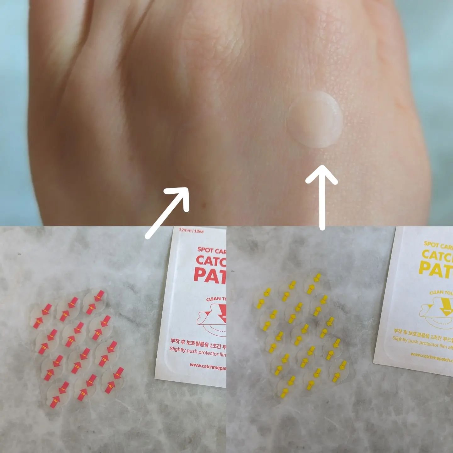 キャッチミーパッチ/CATCH ME PATCH/にきびパッチを使ったクチコミ（3枚目）