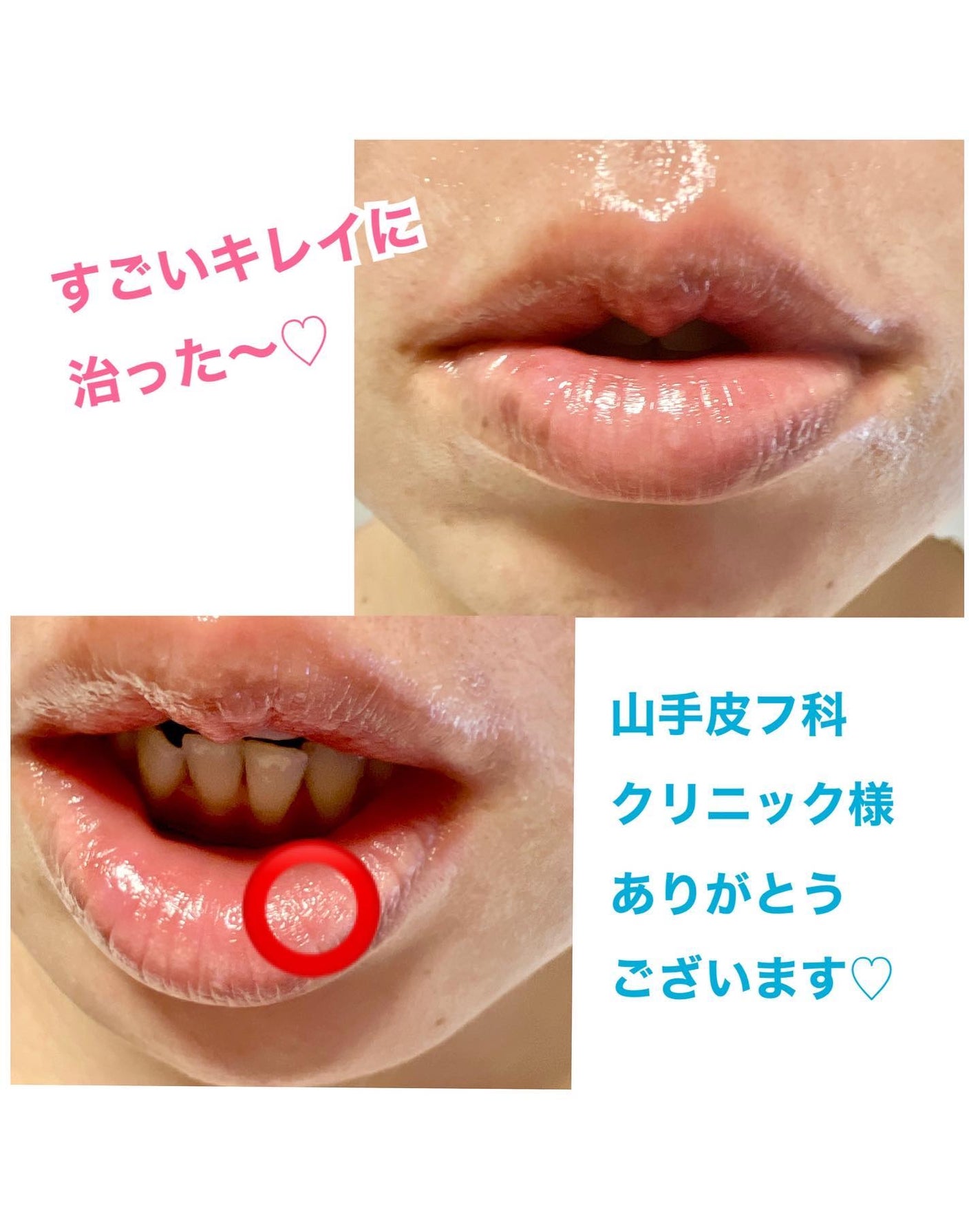 のんたん旅うさぎ on LIPS 「★唇🫦のホクロを取ったハナシ★最近、yamate_hifuka..」(3枚目)