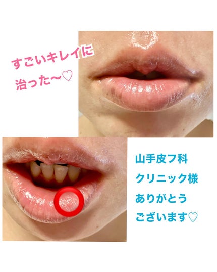 のんたん旅うさぎ on LIPS 「★唇🫦のホクロを取ったハナシ★最近、yamate_hifuka..」(3枚目)
