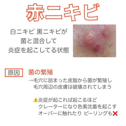 みん on LIPS 「みなさんはニキビの種類についてご存知ですか??また自分のニキビ..」(4枚目)