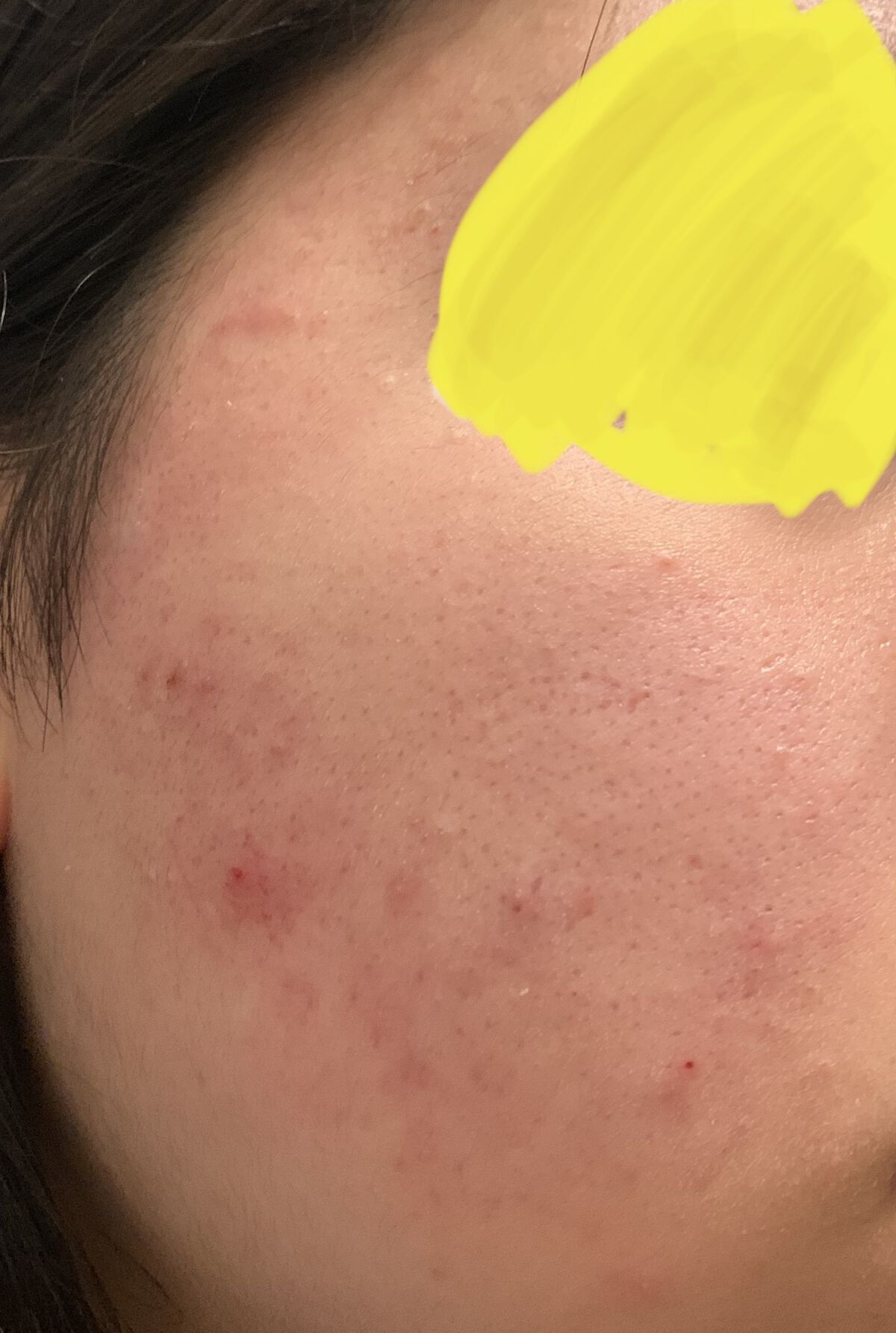 オードムーゲ 薬用ローション（ふきとり化粧水）/オードムーゲ/拭き取り化粧水を使ったクチコミ（3枚目）