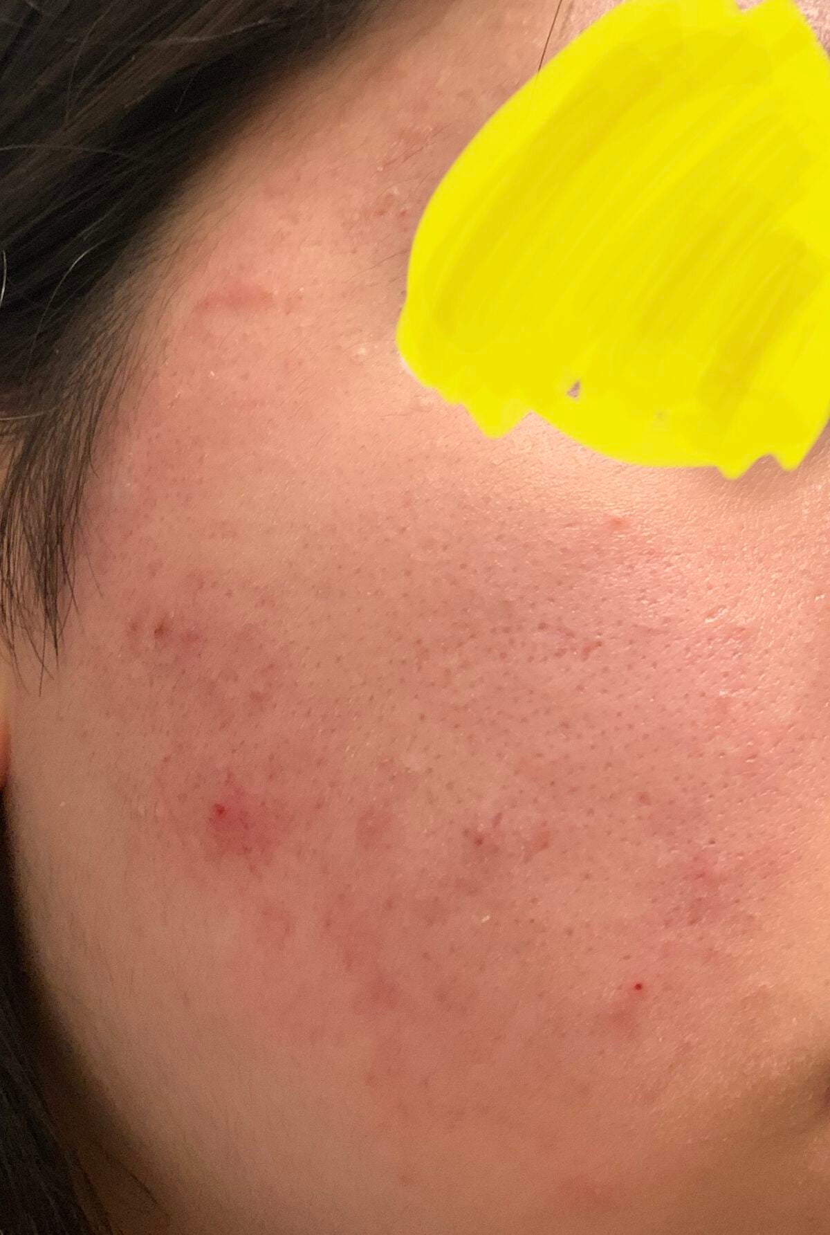 オードムーゲ 薬用ローション(ふきとり化粧水)/オードムーゲ/拭き取り化粧水を使ったクチコミ(3枚目)