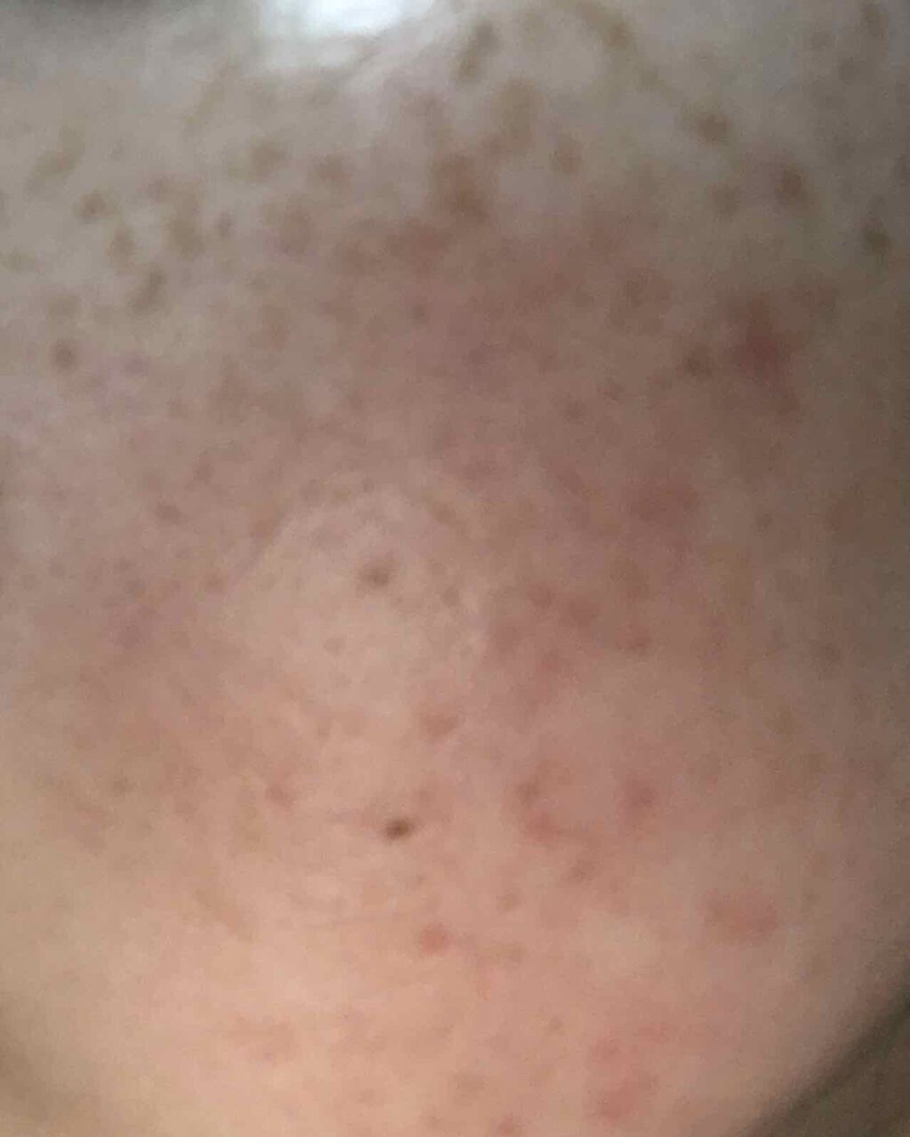 かな on LIPS 「全然投稿してませんでしたが写真は今の肌の状態です1ヶ月アキュテ..」(3枚目)