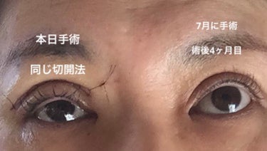 おみなえしこけし on LIPS 「眼瞼下垂切開法による手術左眼に続き右眼も手術しました。前回の左..」（3枚目）