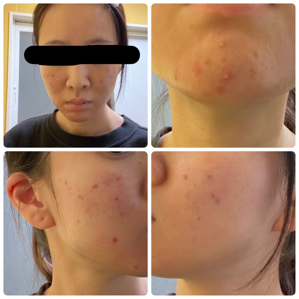 試してみた】AHAマイルドソープ イデアルポーの効果・肌質別の口コミ