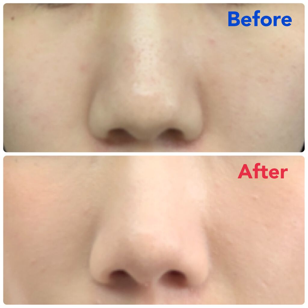 ミノン アミノモイスト モイストチャージ ローションII もっとしっとりタイプ/ミノン/化粧水を使ったクチコミ（3枚目）