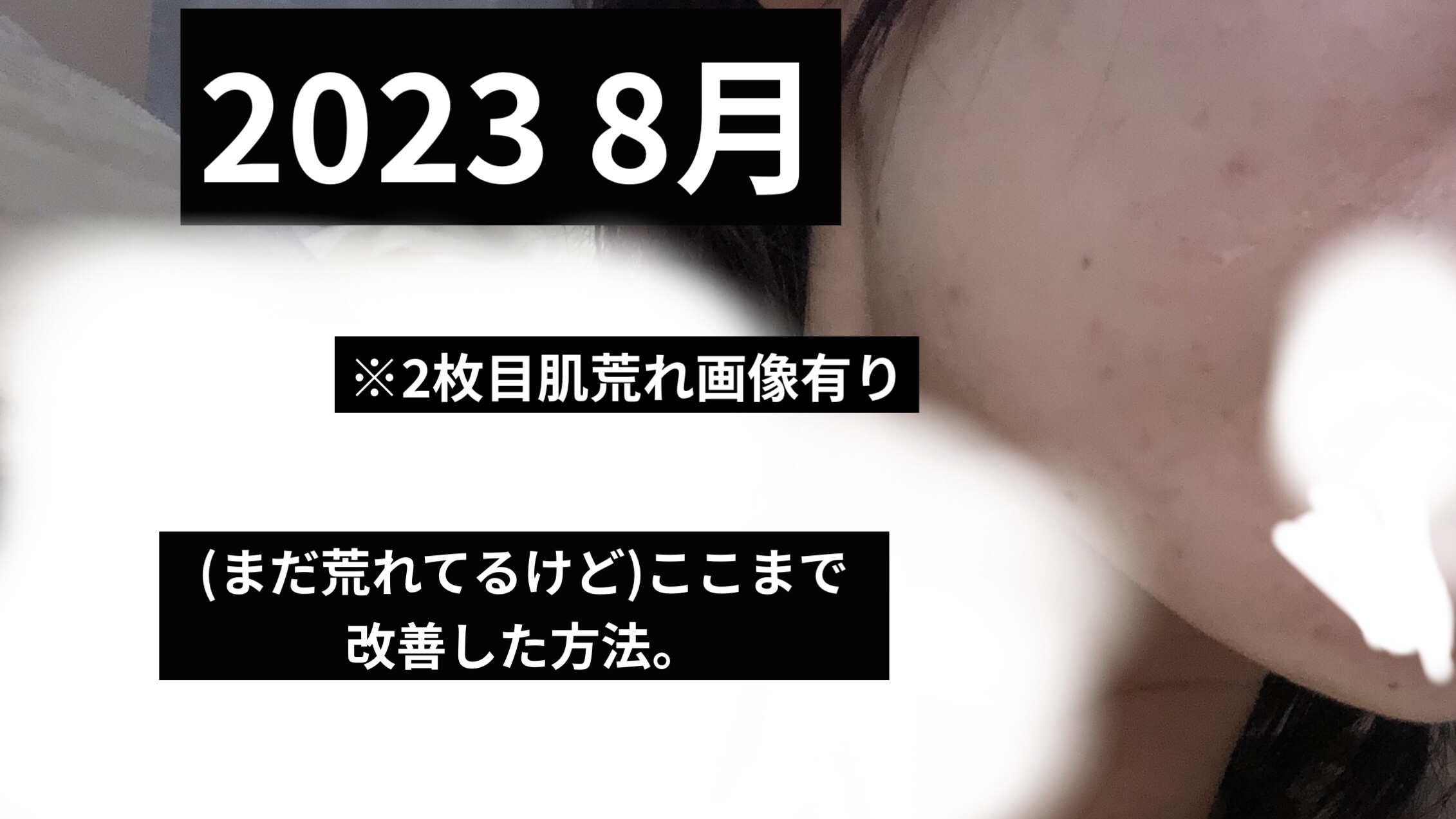 ノブ Ａ アクネソープ/NOV/洗顔石鹸を使ったクチコミ（1枚目）