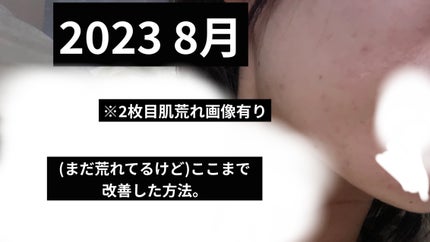 ノブ A アクネソープ/NOV/洗顔石鹸を使ったクチコミ(1枚目)