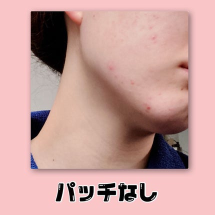 ゼロスポットパッチ/Today’s Cosme/にきびパッチを使ったクチコミ(3枚目)