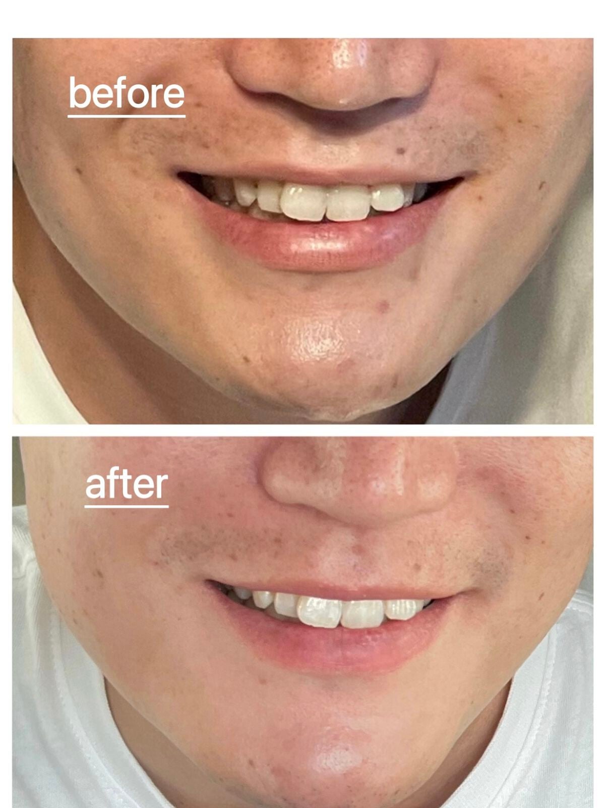 リアルカロテンブレミッシュクリアセラム/APRILSKIN/美容液を使ったクチコミ(3枚目)