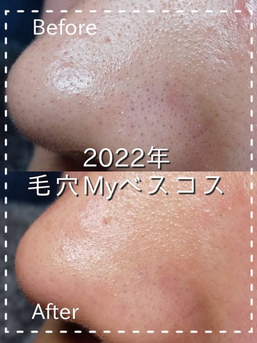 【今年最後に鼻の大掃除🧹  1番良かったアイテム👃🏻】

🌿CNP Laboratory ブラックヘッド クリアキット
   ￥2,000~2,500 /12回分  (Qoo10)

画像は1回分を使用した様子です！
今年使った中ではこれが1番楽で効果がありました🥰

✔️使い方
①シート1を貼って10~15分放置。毛穴が開いて角栓が飛び出てくる。
②付属の綿棒で角栓を絡め取る。
③洗い流す。
④シート2を貼って5~10分。毛穴を引き締める。

鼻がツルツルになって気持ち良いです😚

安いのか高いのか微妙な値段ですが、私は月1でしか使わないので1年もちます👍

#毛穴 #ブラックヘッド  #期待越えアイテム  #いちご鼻の画像 その0